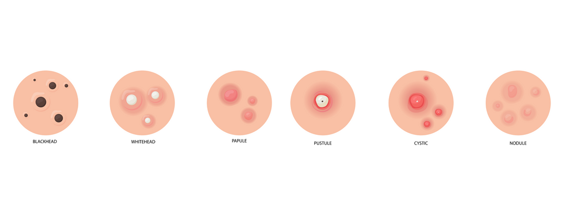 Types of Acne: Causes, Symptoms, and Effective Treatments