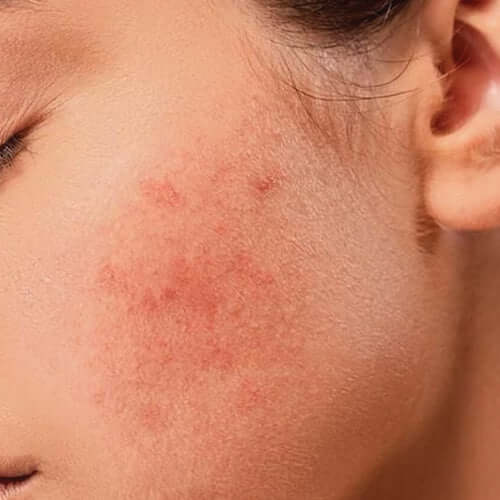 Skin-sensitive.jpg__PID:86f42ca9-a37e-413d-af9a-944eb9e41d39