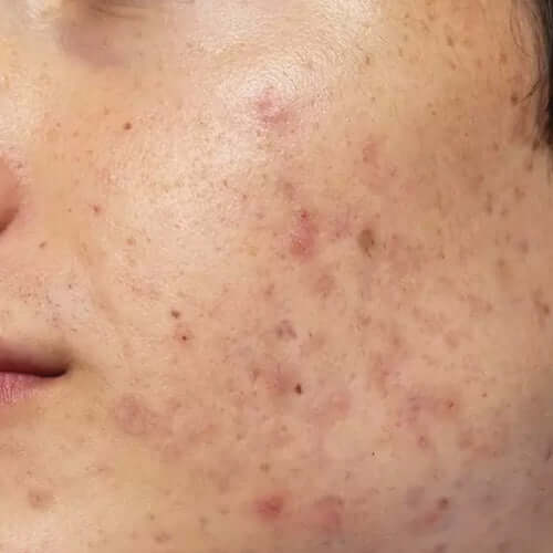 skin-acneprone.jpg__PID:71022535-1da9-4c26-86f4-2ca9a37ee13d