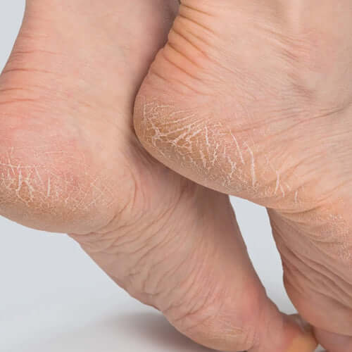 skin-cracks.jpg__PID:25351da9-7c26-46f4-aca9-a37ee13def9a