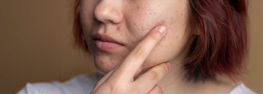 Understanding Comedogenicity in Skincare: What You Need to Know