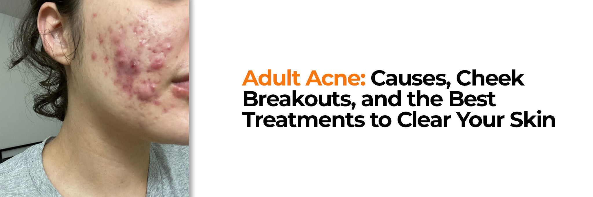 Image of Adult Acne on Cheeks and Jawline: Causes and Treatment Guide