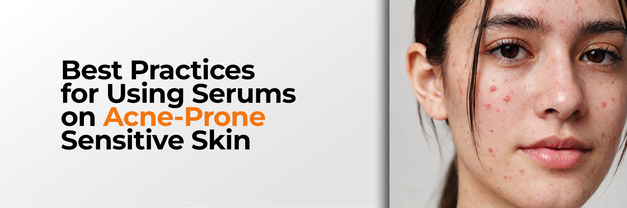 Acne Serums for Sensitive Skin: How to Choose and Use Them