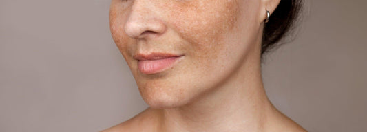 Best Ways to Remove Dark Spots On The Face