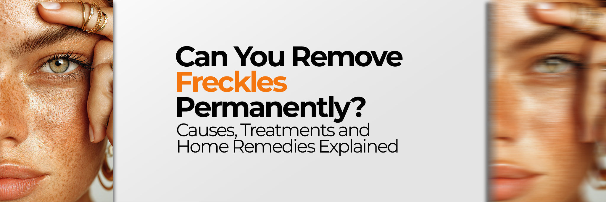 Freckles on the Face: Causes, Treatment Options and Prevention