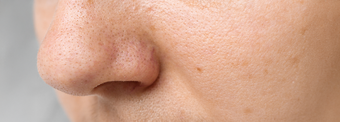 Clogged Pores: Causes, Treatment, and Prevention