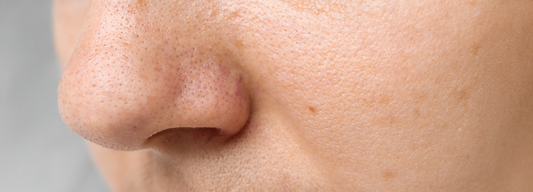 Clogged Pores: Causes, Treatment, and Prevention