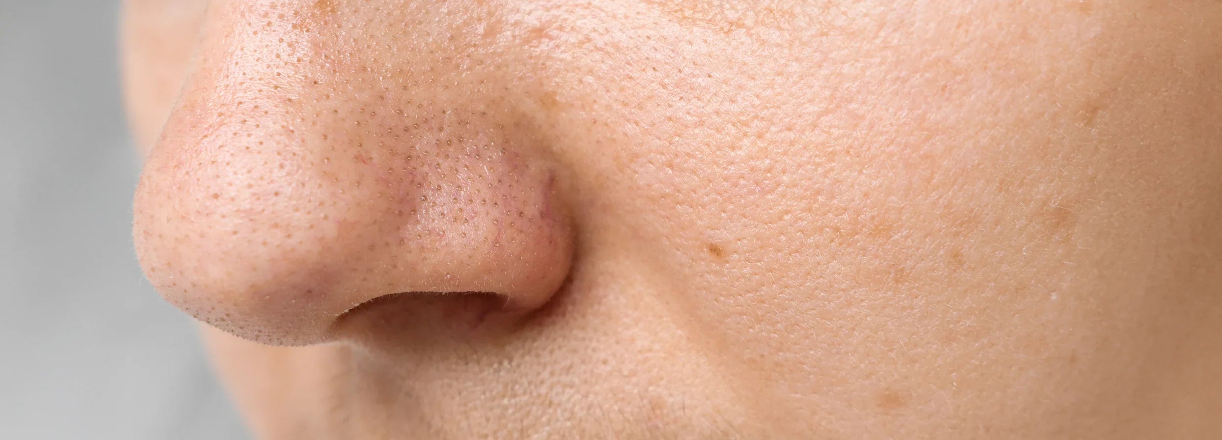 Image of Clogged Pores: Causes, Treatment, and Prevention