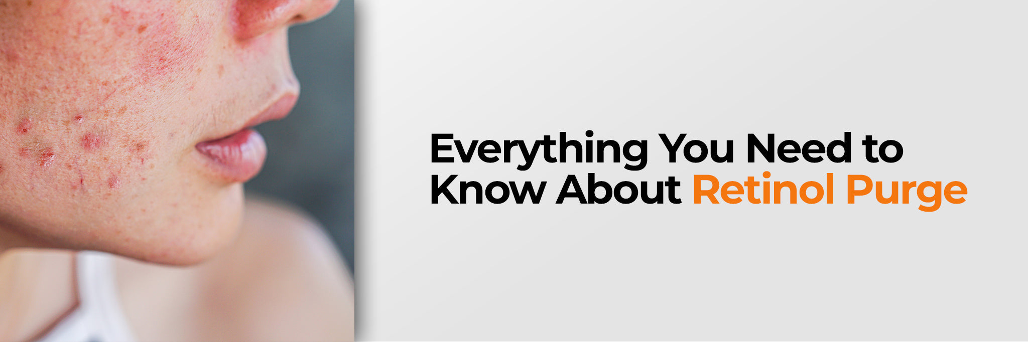 Image of Everything You Need to Know About Retinol Purge