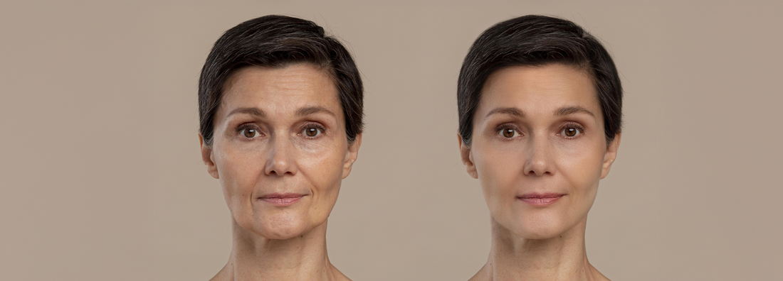 Fine Lines vs Wrinkles: How to Prevent and Reduce Them