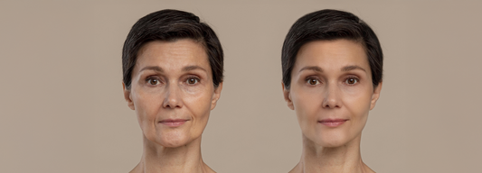 Fine Lines vs Wrinkles: How to Prevent and Reduce Them