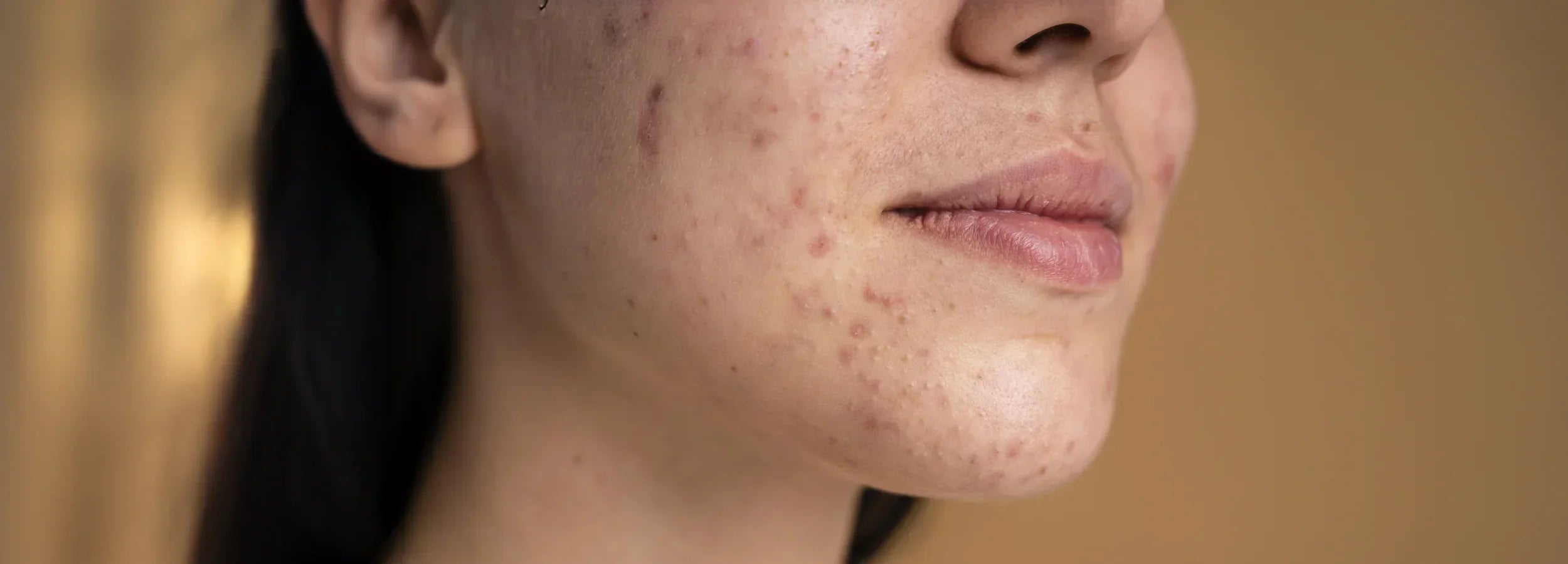 Image of Hormonal Acne: Signs, Causes and Evidence-Based Treatment Options