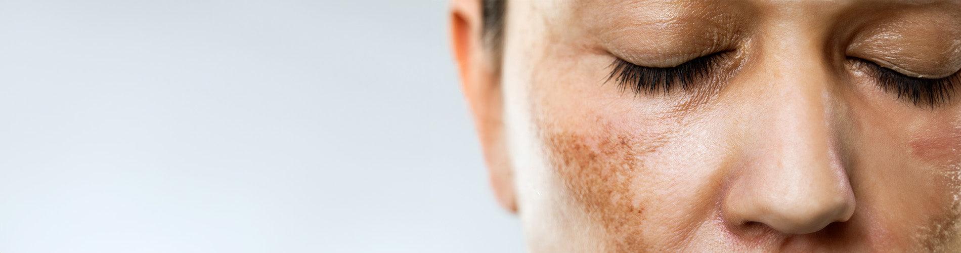 Sunscreen for Hyperpigmentation: UVA, Visible Light and Dark Spots