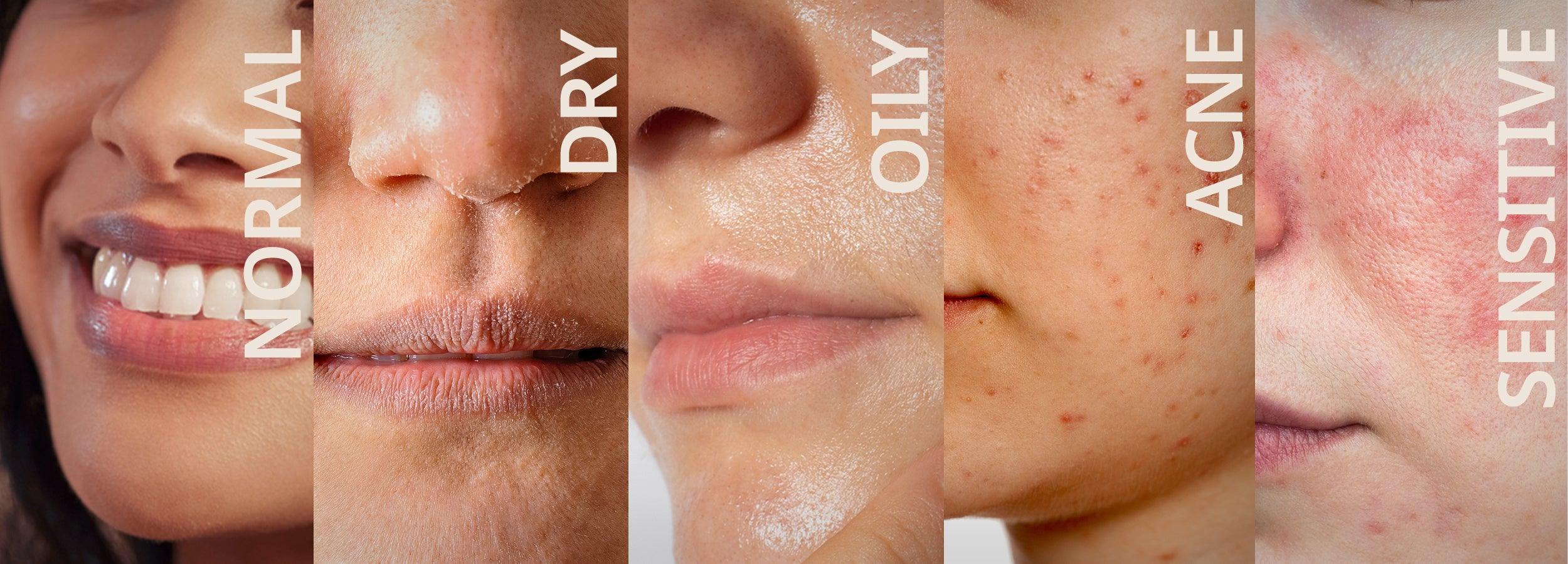 Skin Type Test: Identify Oily, Dry, Combination or Sensitive Skin