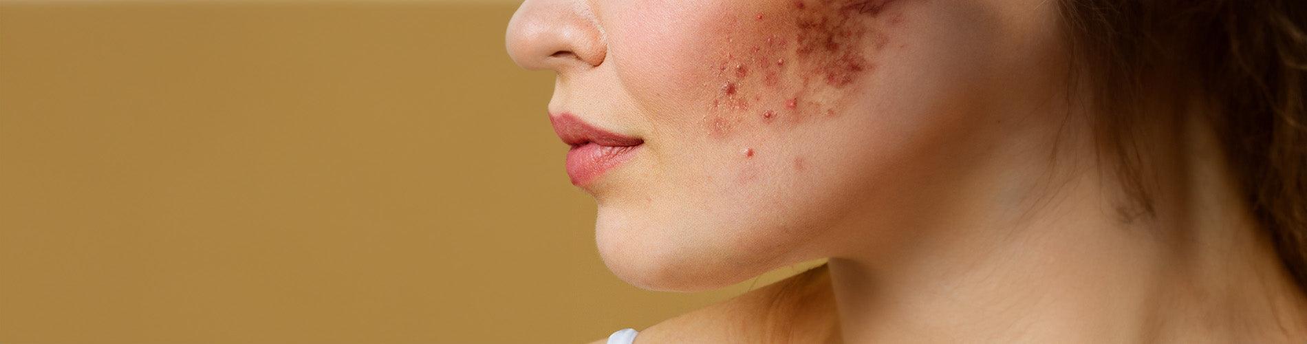 Image of Sunscreen for Acne-Prone Skin: What to Look For