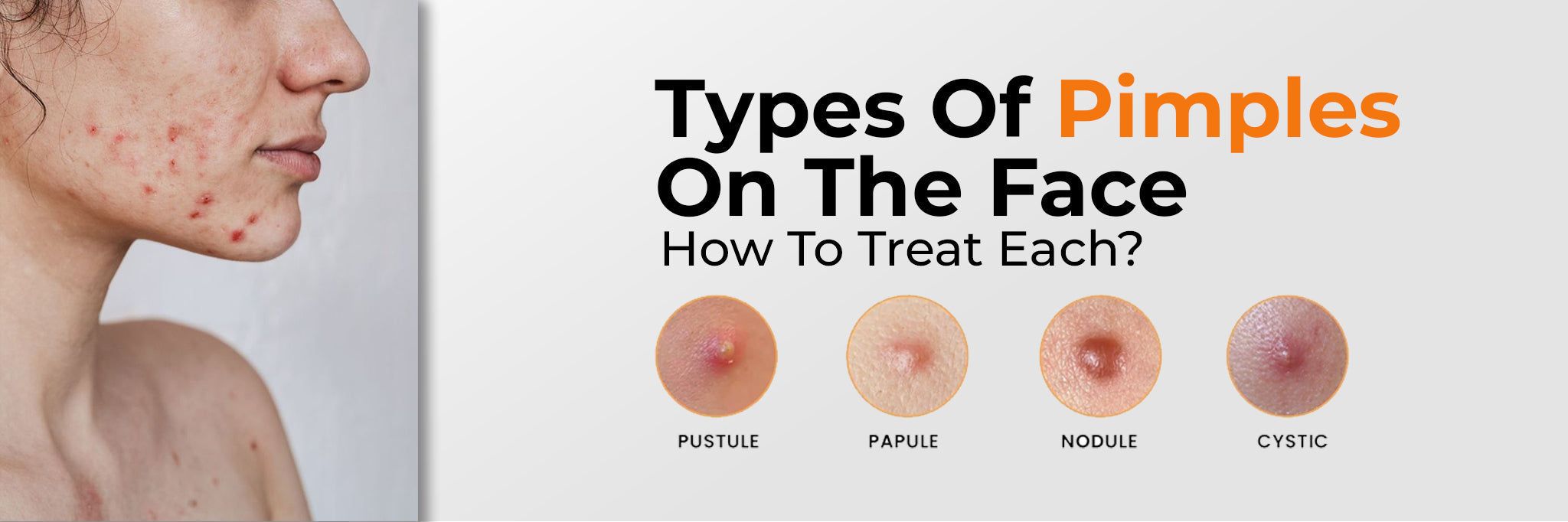 Image of Pimple Types on the Face: Causes and Targeted Treatment