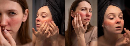 Unveil the Types of Sensitive Skin and How to Care for Them