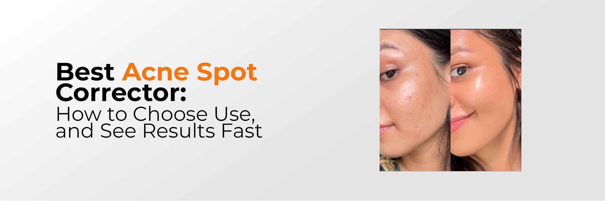 Acne Spot Treatments: How to Choose and Apply Them Correctly