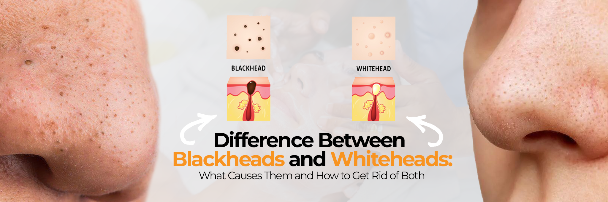 Difference Between Blackheads and Whiteheads: What Causes Them and How to Get Rid of Both