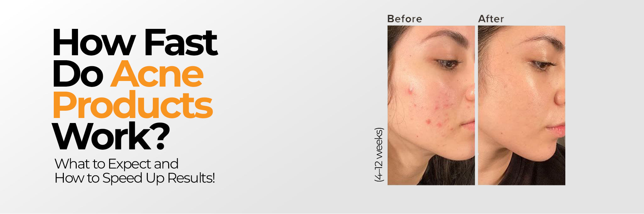 How Fast Do Acne Products Work? What to Expect and How to Speed Up Results