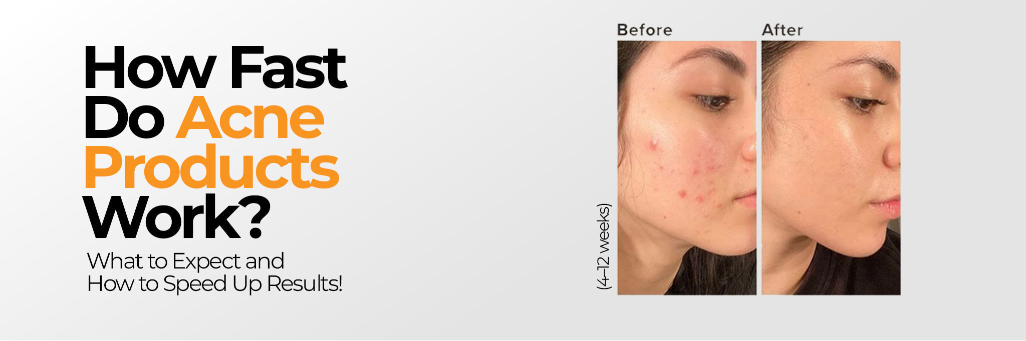 How Long Do Acne Treatments Take to Work? A Results Timeline