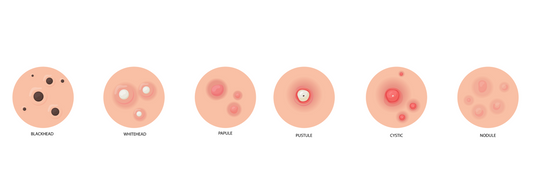 Types of Acne: Causes, Symptoms, and Effective Treatments