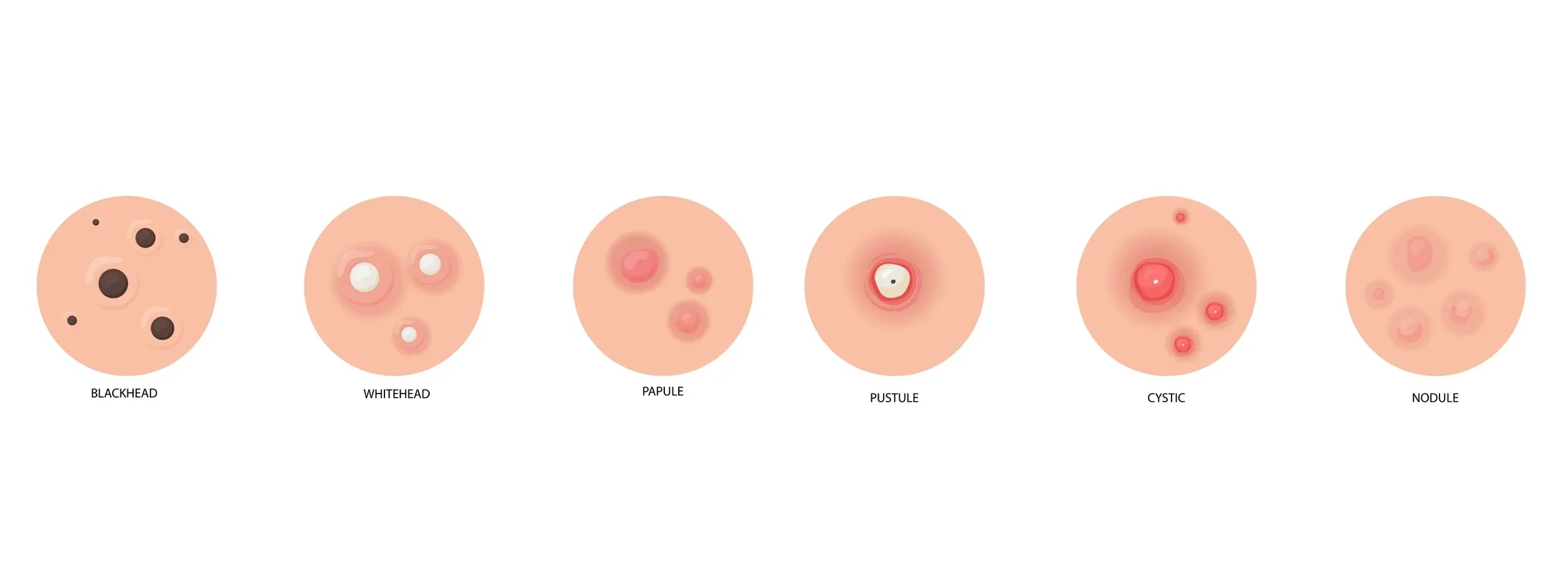 Acne Types Explained: How to Identify and Treat Each One
