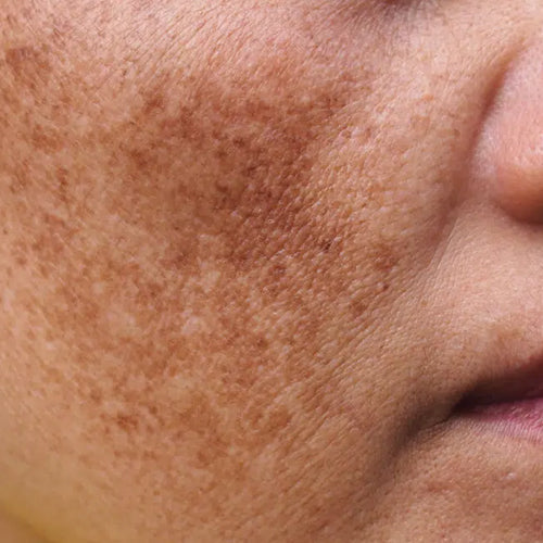 Hyper Pigmentation