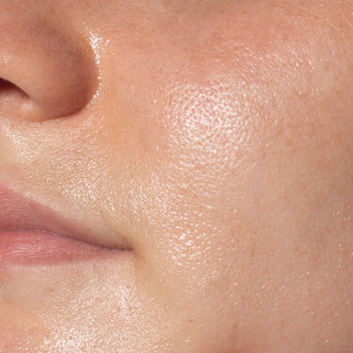 Skin-Oily.jpg__PID:7c2686f4-2ca9-437e-a13d-ef9a944eb9e4