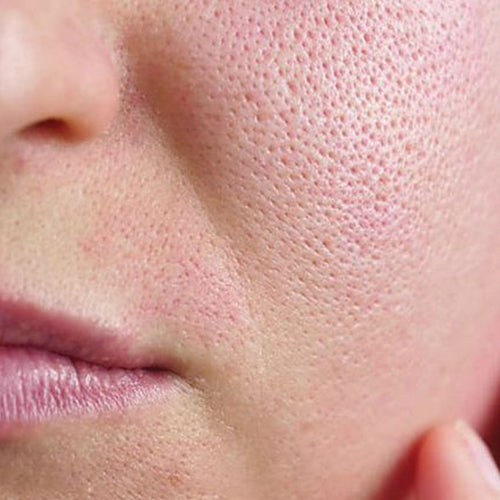 Skin-pore.jpg__PID:2686f42c-a9a3-4ee1-bdef-9a944eb9e41d