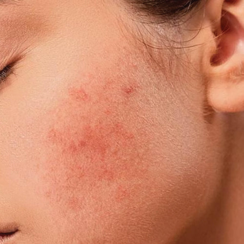 Skin-sensitive.jpg__PID:86f42ca9-a37e-413d-af9a-944eb9e41d39