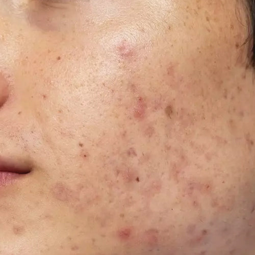 skin-acneprone.jpg__PID:71022535-1da9-4c26-86f4-2ca9a37ee13d