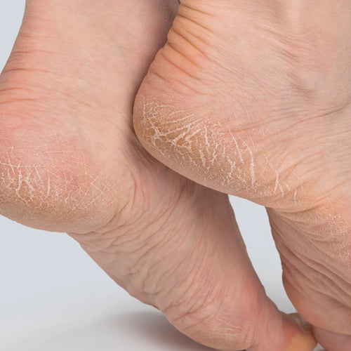 skin-cracks.jpg__PID:25351da9-7c26-46f4-aca9-a37ee13def9a