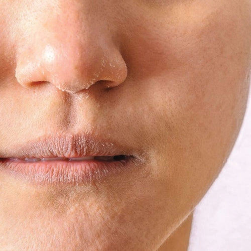 skin-dry.jpg__PID:351da97c-2686-442c-a9a3-7ee13def9a94